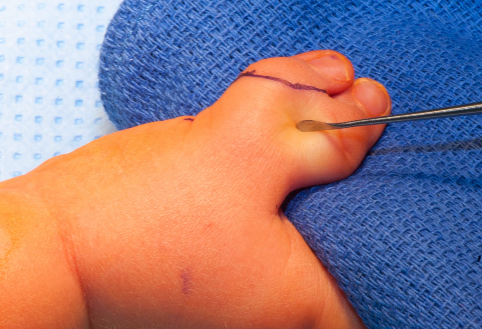 The Extra Thumb Congenital Hand and Arm Differences