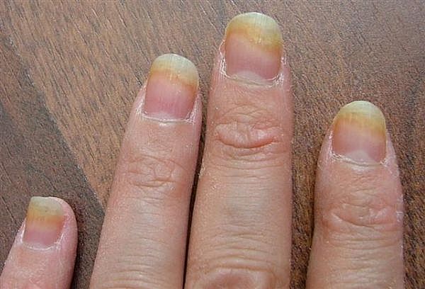 Nail Fungus Pictures