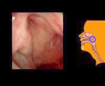 Atlas nội soi tai mũi họng - Tài liệu học tập bác sĩ đa khoa