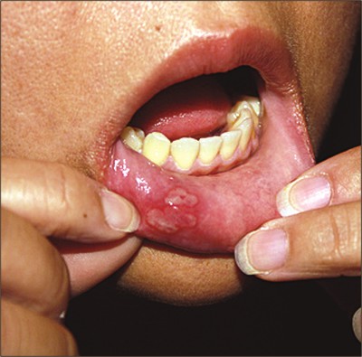 Oral steroid for eczema