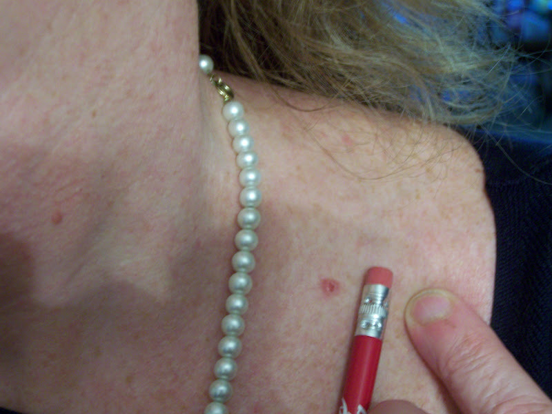 Kristin BerkeyAbbott My Third Skin Cancer