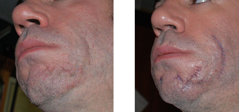 laser tattoo removal work laser tattoo removal work
