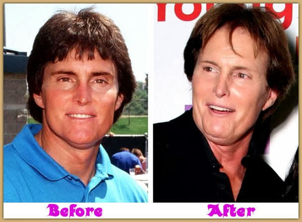 Bruce Jenner Plastic Surgery Before and After Facelift, Skin cancel