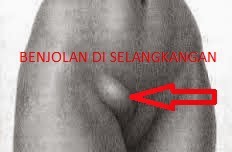 Grosir Ace Maxs Dan Gold G Obat Tradisional Benjolan Di