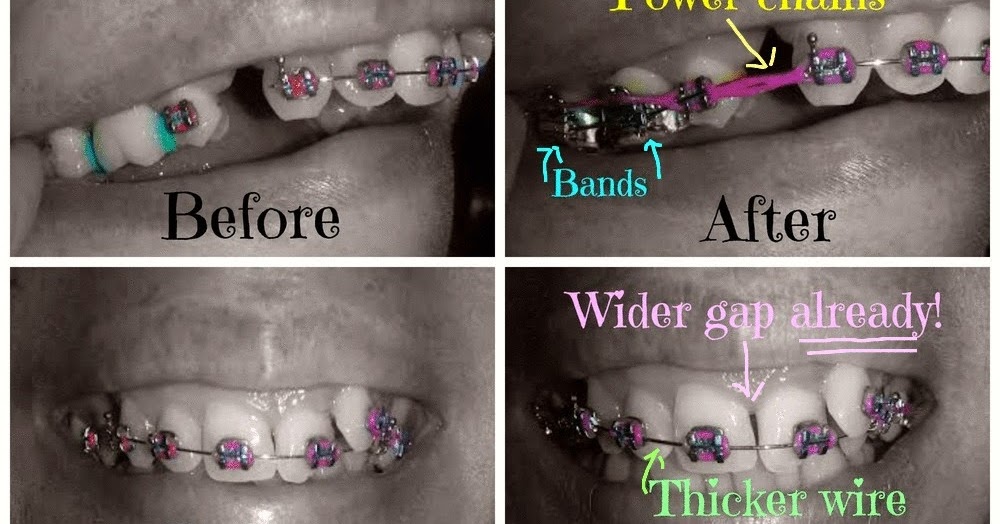 Adult Braces My Journey 1st Adjustment Con't. Power Chains, Bands