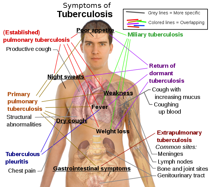 tuberculosis symptoms