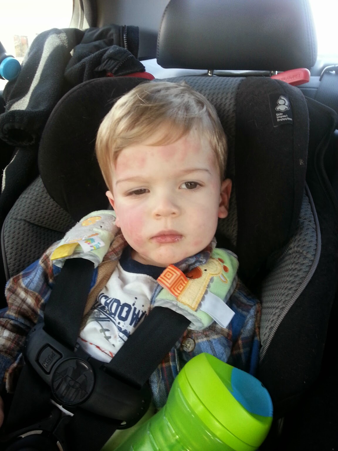 joel and his rash allergic reactions or viral infection