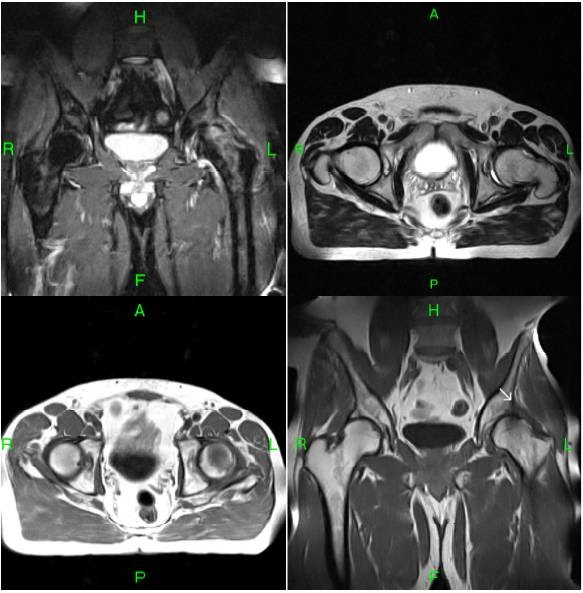FemoroAcetabular ImpingementMRI Sumer's Radiology Blog