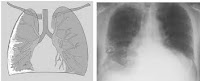 El mesotelioma es una rara forma de cáncer casi exclusivamente causada por la exposición al asbesto . El mesotelioma pleural es el tipo más común de mesotelioma , un cáncer raro que se desarrolla ...