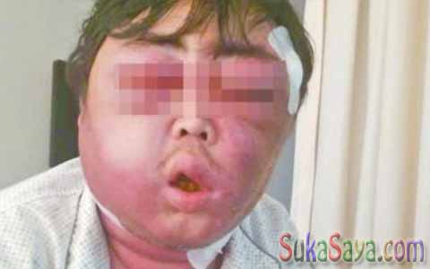 Wajah Pria Ini Bengkak Bukan Karena Dipukul, Melainkan Karena Seekor Nyamuk Wajah Pria Ini Bengkak Bukan Karena Dipukul, Melainkan Karena Seekor Nyamuk