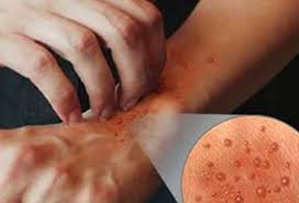 cara mengobati dermatitis