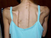 anorexia anorexia