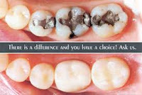 dental filling procedure