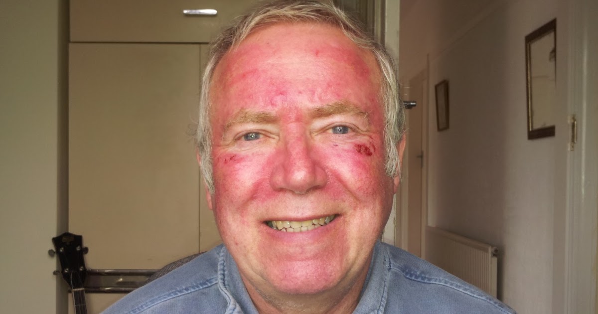 Alan's Efudix/Efudex Experience