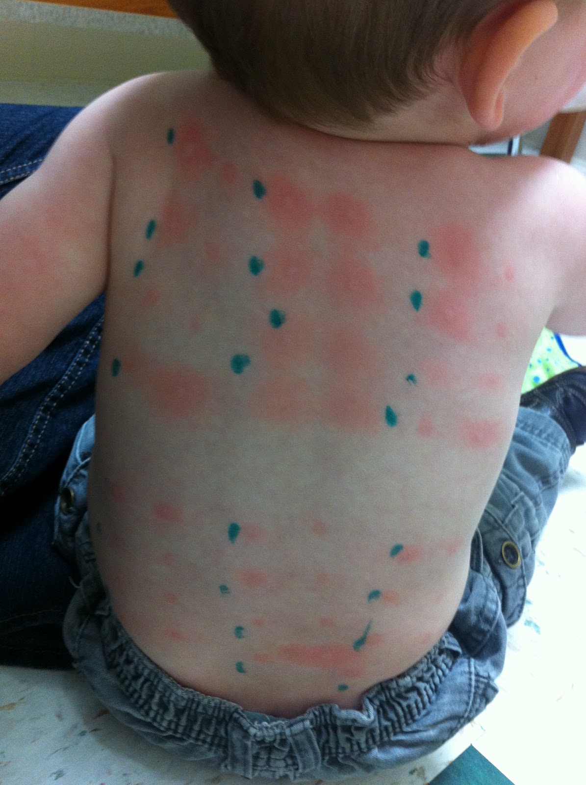 Aidan... With Eos Update April 11th Allergy