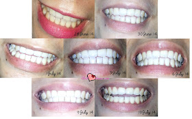 Caritapremium Buy Teeth Whitening 15