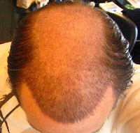 hair loss