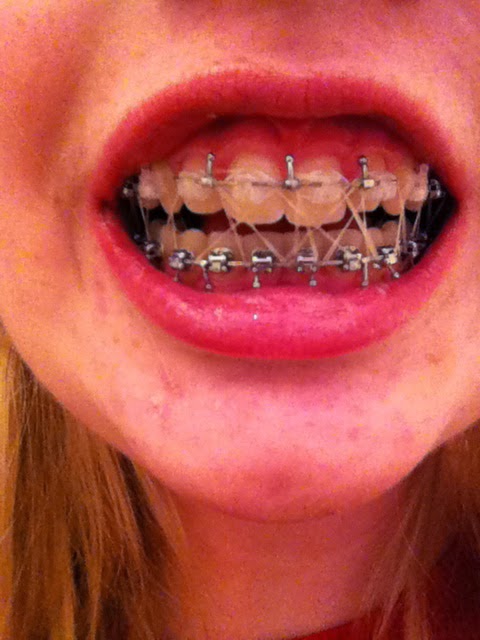 jaw surgery braces bands double katie six before many