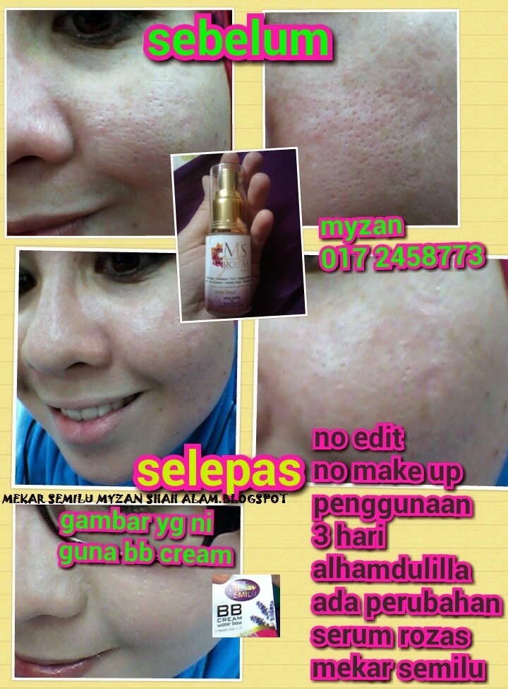 Ms Skinz Stokis 0172458773 Free Pos Laju Ezany Nizariff Hasil Serum Rozas Mekar Semilu Dalam 3 Hari Alhamdulilla Nampak Kurang Lubang Pori Di Muka Best Guna Rasa Lembab Jer Muka Rugi Tak Cuba Rm 89 00 Free