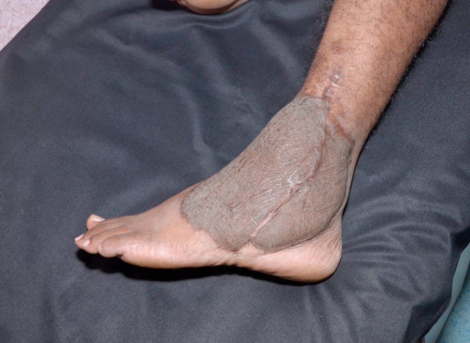 CRUSH INJURY FOOT OPEN ANKLE JOINT FREE LATISSIMUS DORSI MUSCLE