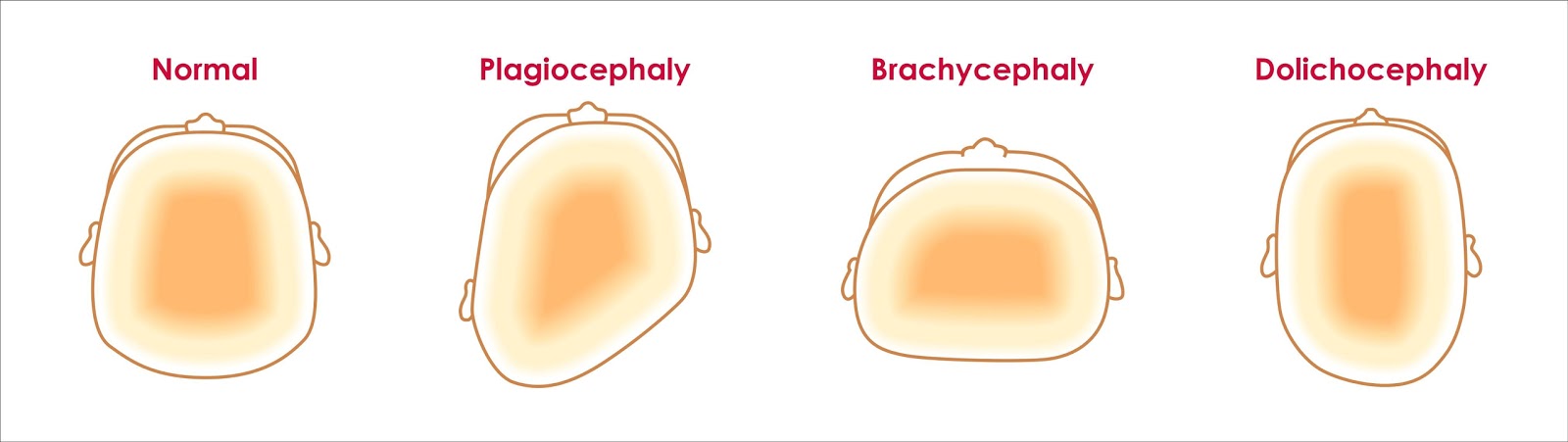 Das Babykissen Mimos Erlaeuterungen zur Plagiozephalie
