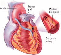 aterosklerosis