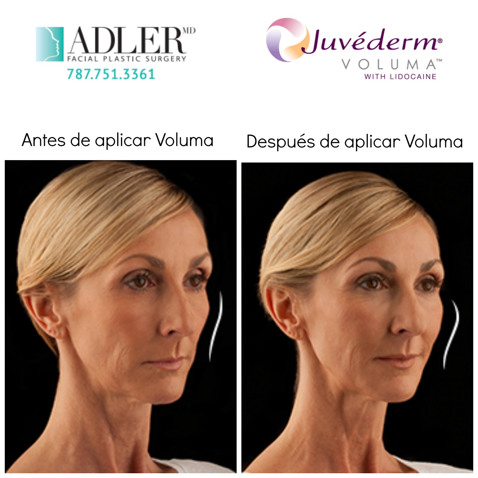 Voluma para aumentar volumen en la cara Dr. Eric Adler, cirujano