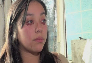 Βίντεο-ΣΟΚ: 20χρονη κοπέλα όταν κλαίει αντί για δάκρυα βγάζει αίμα 