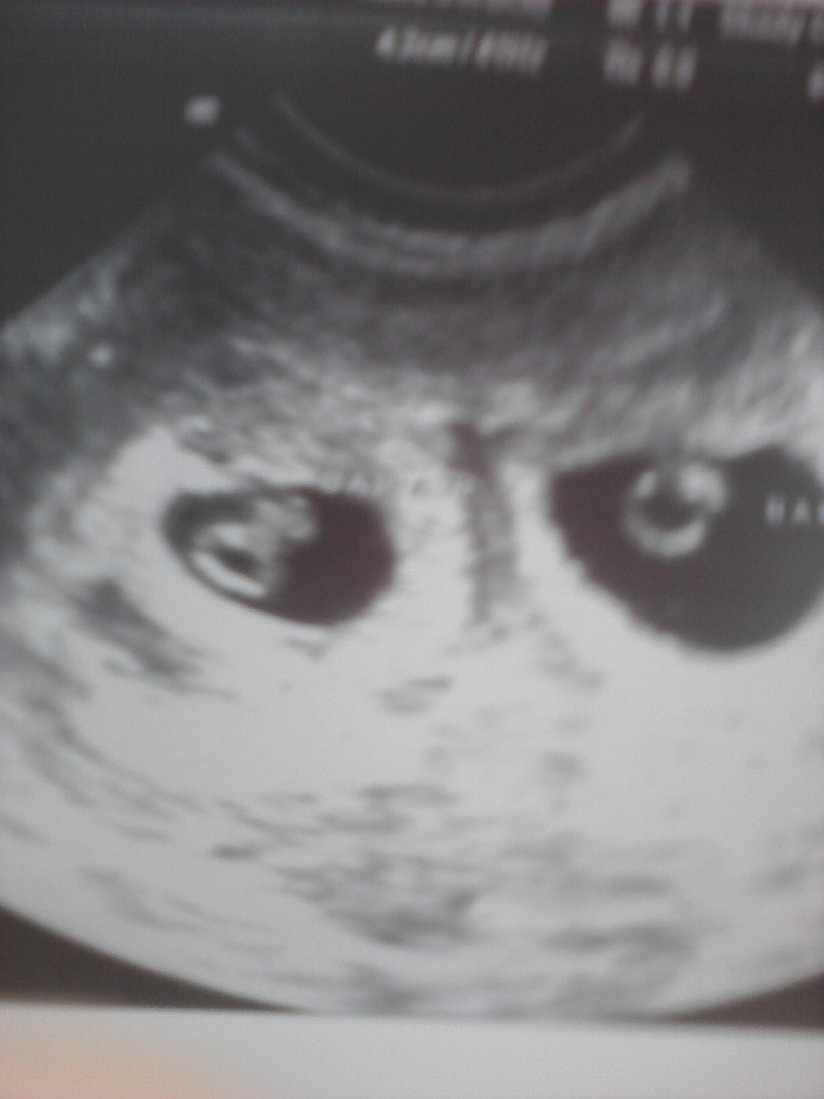 Sonogram 2 Weeks