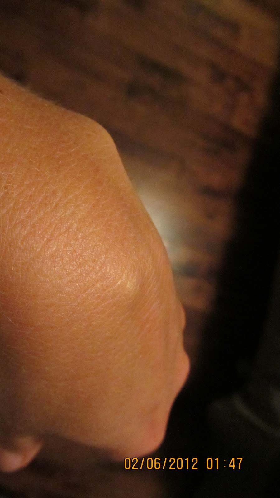 Wrist Lump