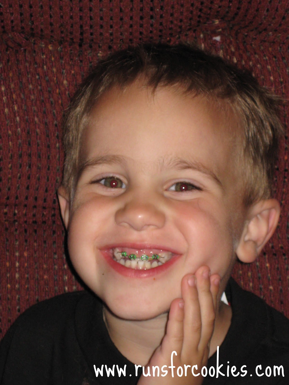 braces on