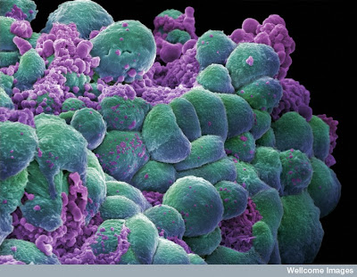طريقة جديدة لقتل الخلايا السرطانية دون الإضرار بالسليمة  Cancer+cell