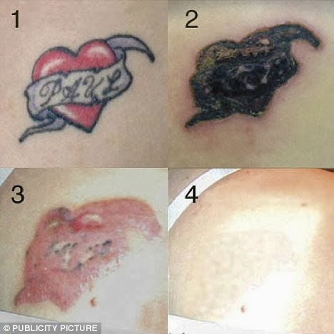 natural tattoo removal natural tattoo removal