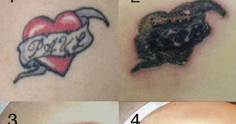 natural tattoo removal rejuvi cream vs natural tattoo removal natural tattoo removal rejuvi cream vs natural tattoo removal
