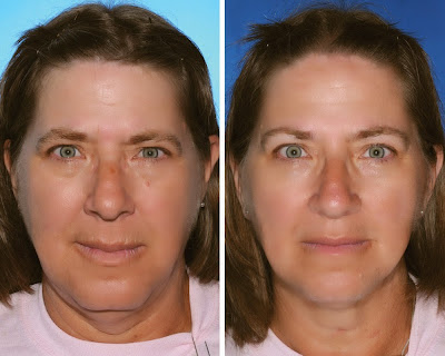 Smoking Adversely Affects Facial Aging