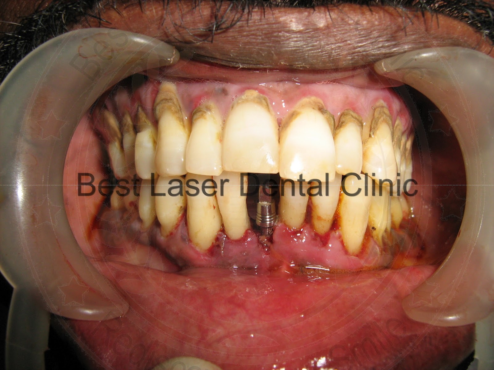 » gallery 2Immediate extraction and NEW TOOTH replacement of single