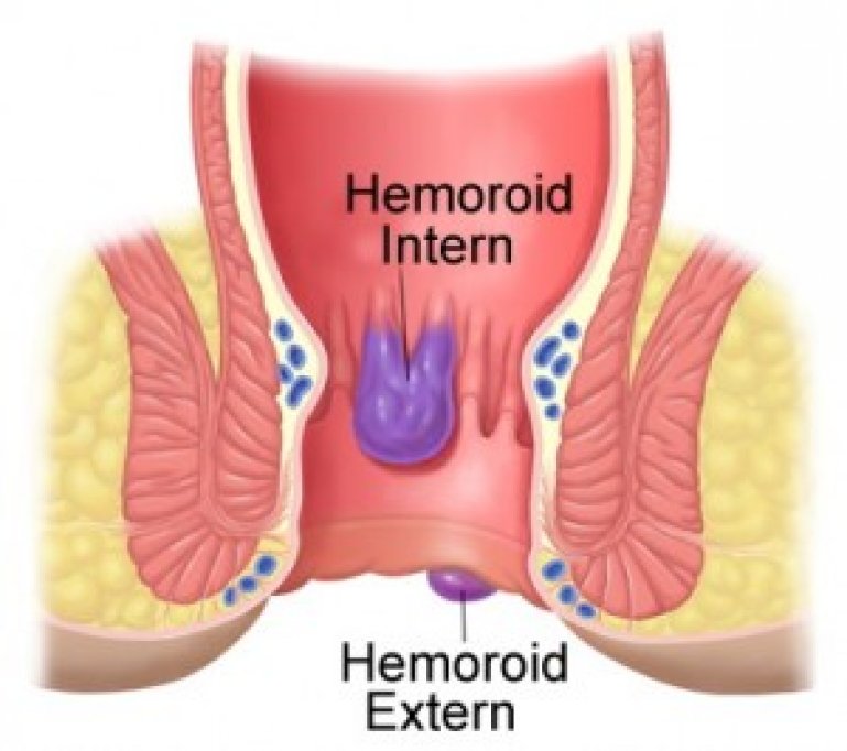 Hemoroizi tratament, Hemoroizi interni , Tratament hemoroizi