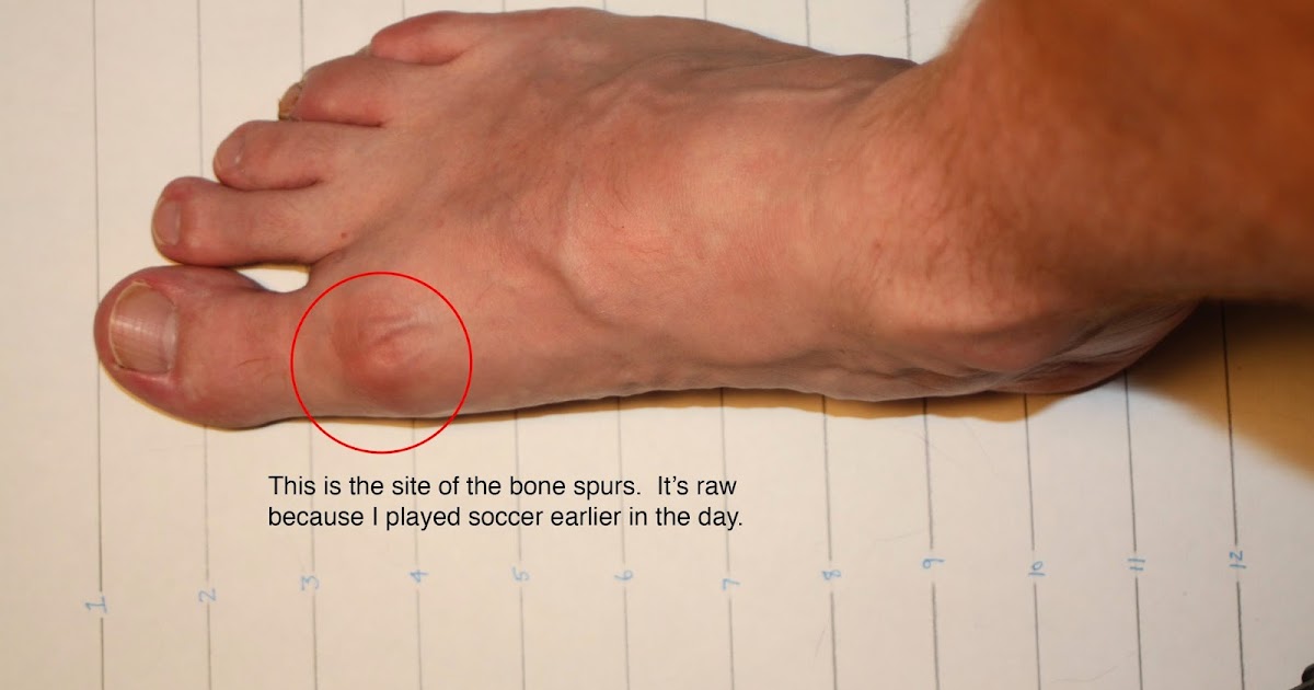 Soccer After 40 Removing my bone spurs