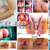 Obat Di Apotik Untuk Berak atau BAB Keluar Darah thumbnail