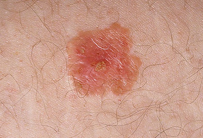 Pictures of skin cancer White spots skin cancer