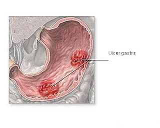 Ulcerul gastroduodenal — Totul despre ulcerul gastroduodenal 