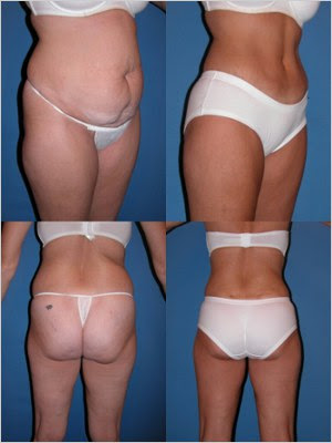 Abdominoplastia como tratamento estétido pode corrigir a flacidez da barriga e a flacidez na barriga. resultados de uma abdominoplastia