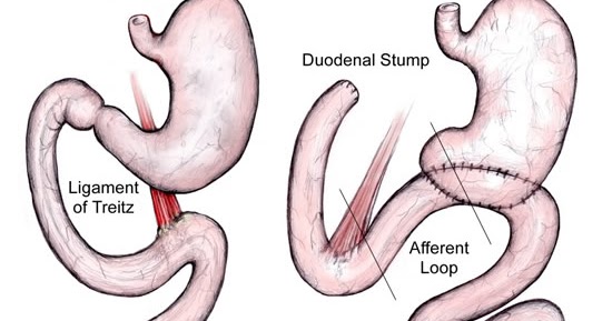 medical science treatment of gastric outlet obstruction gastric outlet obstruction