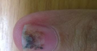 How to Cure dark toenails: How to cure dark toenails
