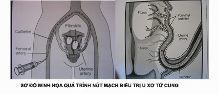 Phương pháp điều trị u xơ tử cung hiệu quả