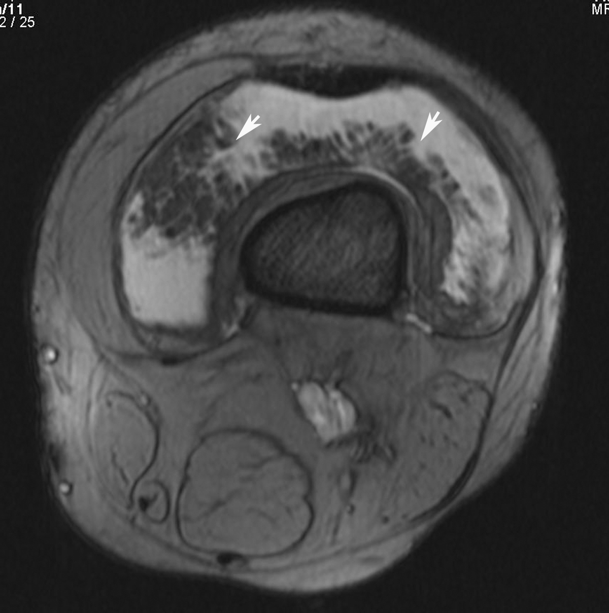 Mri Knee