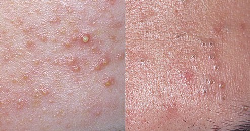 skin problems during pregnancy