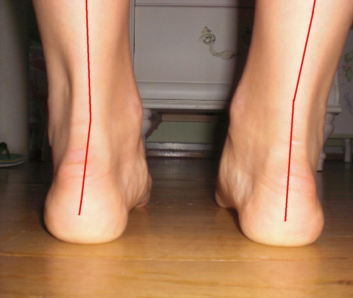 an american ballerina injuries and problems associated with flat feet