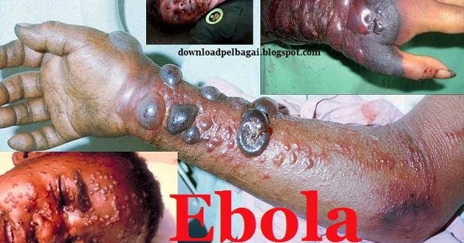 10 Tips Cegah Dijangkiti Ebola | Download Percuma