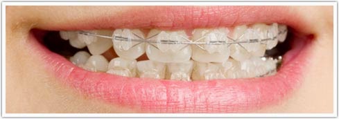  Ceramic Braces